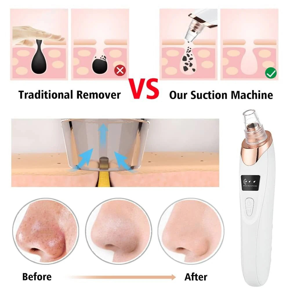 Electric Blackhead Remover Vacuum – Deep Pore Cleansing Facial Cleaner | Premium Quality